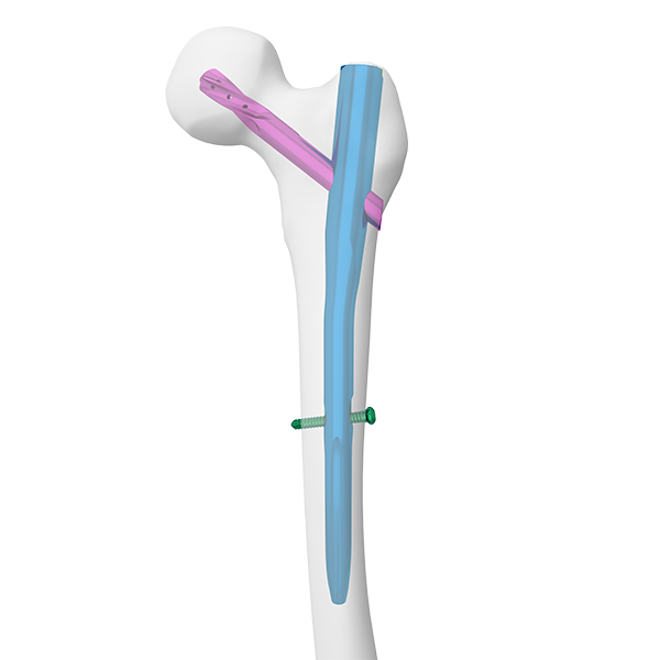 APFN Aimstrong proximaler Femoral-Nagel